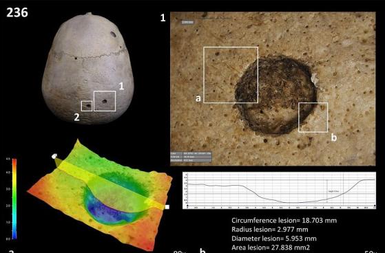 Antigos egípcios poderão ter tentado tratar o cancro há 4000 anos